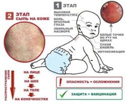 Корь. Последствия пандемии COVID-19